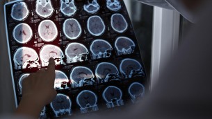 Alzheimer a 19 anni, segnalato caso più precoce al mondo