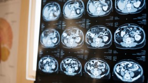 Alzheimer, scoperto in Italia nuovo gene che lo provoca: lo studio