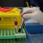 Alzheimer, via libera a test del sangue per diagnosi: cosa significa