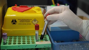 Alzheimer, via libera a test del sangue per diagnosi: cosa significa