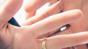 Anello troppo stretto al dito, servono i pompieri