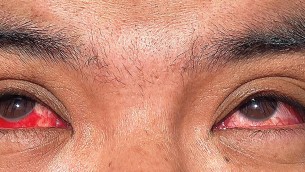 Aviaria, ecco i sintomi del primo uomo infettato