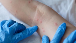 Boom di casi di scabbia, nuova cura risolutiva da antica ricetta: lo studio al Meyer