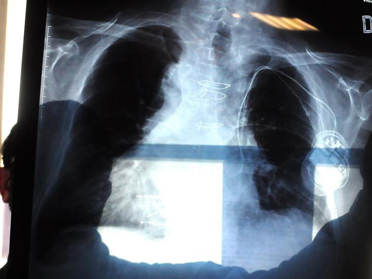 Cancro ai polmoni, individuato il punto debole: è nel 'motore' che lo fa crescere