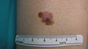 Cancro, oncologo: "Tre anni per vaccino mRna contro melanoma"