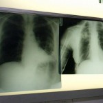 Cancro polmone a piccole cellule, ok Ue a tislelizumab