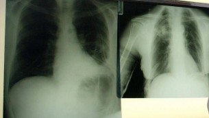 Cancro polmone a piccole cellule, ok Ue a tislelizumab