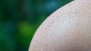 Cos'è il melanoma? Sintomi, prevenzione e successi dell'immunoterapia