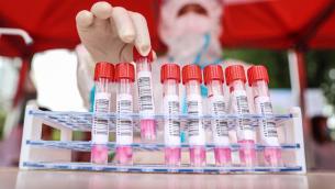 "Il Covid diventerà endemico, pandemia tutt'altro che finita"