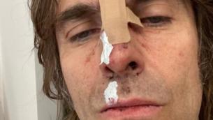 Liam Gallagher cade dall'elicottero e si ferisce