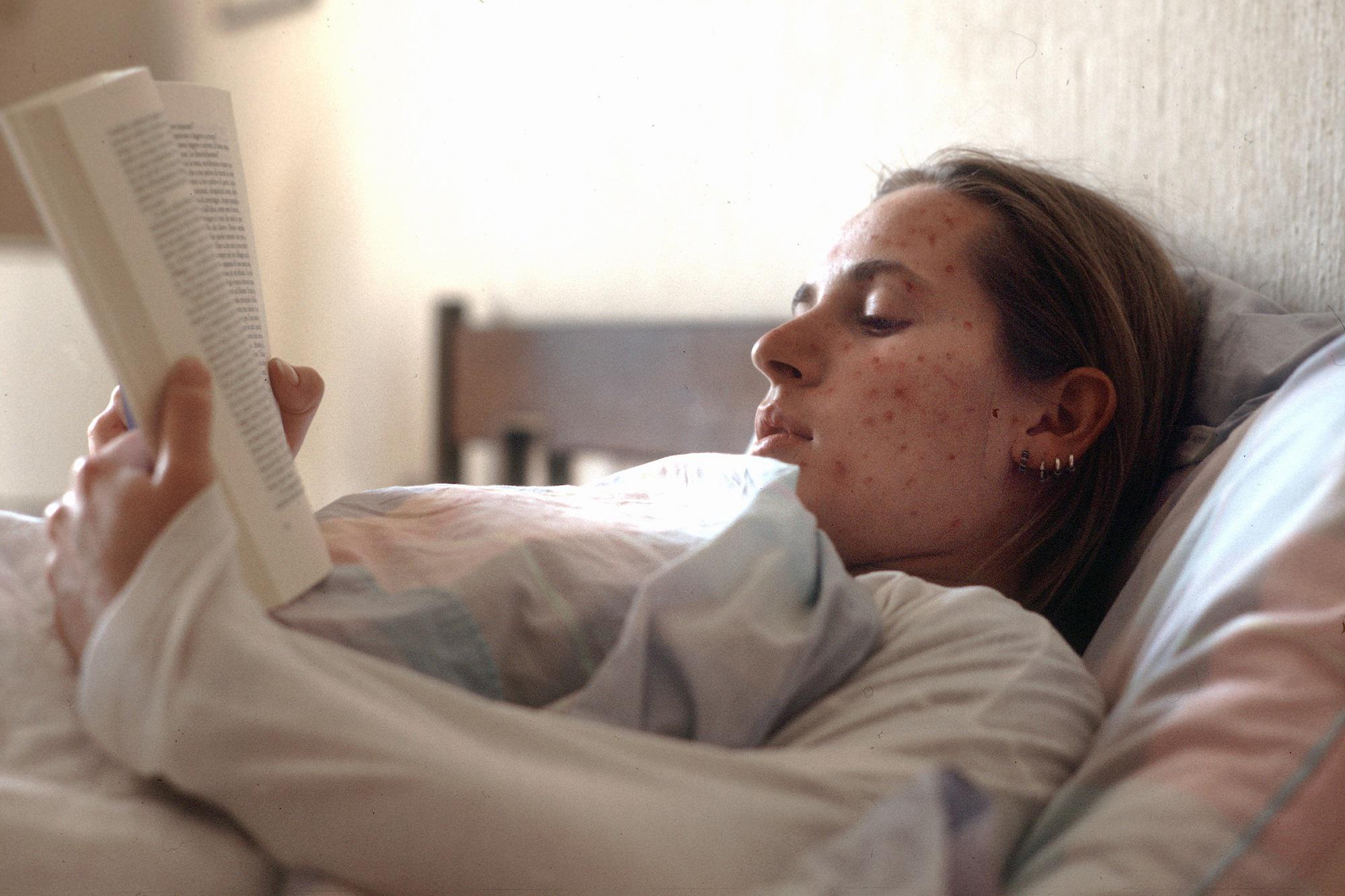 Morbillo, è allarme in Europa: 7 morti in un mese