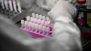 Rischio Long Covid, scoperta variante genetica che lo aumenta del 60%
