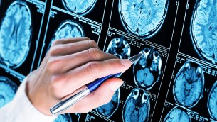 Sin e SinDem: "Sì Ema a lecanemab luce in fondo al tunnel per Alzheimer"