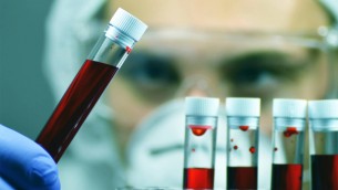 Tumori, Ue approva terapia per adulti con leucemia linfatica cronica refrattaria